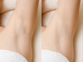 Women underarm hair removal before and after