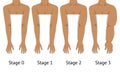 Women's arms in different stages of Lymphedema