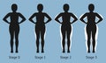 Women's body in different stages of Lipedema
