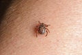 Forest mite on the skin. wood tick Royalty Free Stock Photo