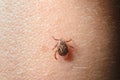 Forest mite on the skin. wood tick Royalty Free Stock Photo