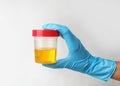 Worker holding jar with urine sample on light background. Urology concept