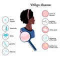 World vitiligo day.Infographics icons with symptoms and reasons of autoimmune sickness.Skin disease. Royalty Free Stock Photo