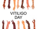 World vitiligo day poster.Hands different ethnicities in various gestures with skin disease.