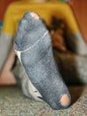 Worn socks with a hole and heel sticking out