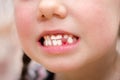 A wound in a child`s mouth without one tooth is close-up. The girl just pulled out her baby teeth. Children`s smile after visiti
