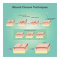 Wound closure techniques.