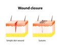 Wound healing process with help surgical suture.