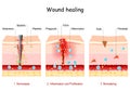 Wound healing. Stages of the post-trauma repairing process Royalty Free Stock Photo