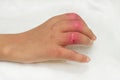 Wound and treatment,Hand Injury