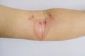 Wounds on arm caused by poisonous insects. Royalty Free Stock Photo