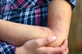 A wounds atepic dermatitis in the hands of a child