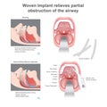 Woven Implant relieves partial obstruction of the airway.