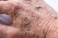 Wrinkled skin on the hand of an older man with some lesions of actinic keratosis