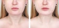 A cosmetologist prepares the patient for surgery: contour plastics of the neck, mesotherapy or botulinum therapy. Wrinkles and