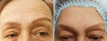 Wrinkles elderly woman face effect collagen hydrating health correction before and after cosmetic procedures, therapy, anti-aging Royalty Free Stock Photo