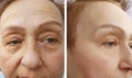 Wrinkles elderly woman face effect hydrating health correction before and after cosmetic procedures, therapy, anti-aging Royalty Free Stock Photo