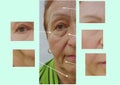 Wrinkles elderly woman face effect rejuvenation health correction before and after cosmetic procedures, therapy, anti-aging Royalty Free Stock Photo