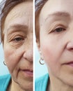 Wrinkles elderly woman face hydrating before and after cosmetic procedures, therapy, anti-aging Royalty Free Stock Photo