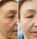 Wrinkles elderly woman face hydrating health correction before and after cosmetic procedures, therapy, anti-aging Royalty Free Stock Photo
