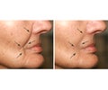 Wrinkles on the face. Flabby skin on the cheeks, Nasolabial wrinkle. Before and after treatment.