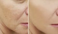 Wrinkles face woman before and after procedures