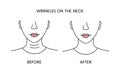 Wrinkles on the neck, laser cosmetology before procedure and after applying treatment line icon in vector. Illustration