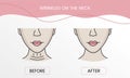 Wrinkles on the neck, laser cosmetology before procedure and after applying treatment in vector. Illustration of a woman