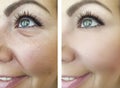 Wrinkles before and after difference,  lifting  correction   results Royalty Free Stock Photo