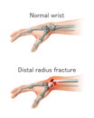 Wrist bone injury. Vecto