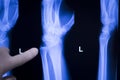 Wrist hand injury xray scan