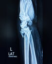 Wrist and hand x-ray PA view showing intra-articular comminuted fracture distal radius. Medical image concept.