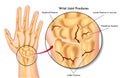 Wrist joint fractures