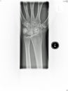 Wrist x-ray Royalty Free Stock Photo