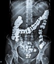 X Ray of Abdomen with large intestine.