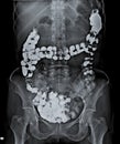 X Ray of Abdomen with large intestine.