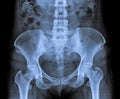 X Ray abdomen and pelvic.