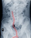 X-ray abdomen DJ stent in right ureter.medical image