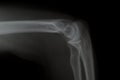 X ray af Elbow
