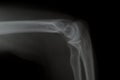 X ray af Elbow Royalty Free Stock Photo