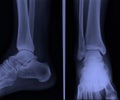 X ray ankle ap lateral