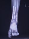 X-ray Ankle joint AP Case fracture distal metaphysis of distal tibia and fibula.Post ORIF with plate and screws.Medical image co Royalty Free Stock Photo