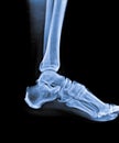 X Ray of Ankle joint