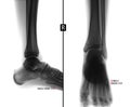 X-ray of the ankle joint. Shows the bony cyst of the fifth finger of the right foot. Marker. Negative. Royalty Free Stock Photo