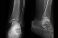 Plain film X-ray of ankle in two projections, radiography Royalty Free Stock Photo