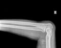 X-ray of arm