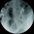 X-ray Barium enema examination (lower gastrointestinal