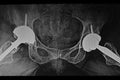 X-Ray of bilateral hip prosthesis Royalty Free Stock Photo