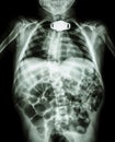 X-ray body of child and tracheostomy tube