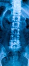 X-ray of the bones of the human lower lumbar part of the vertebral column